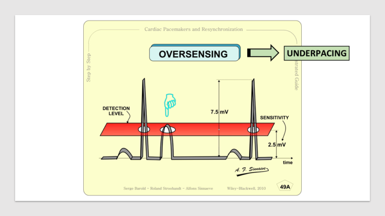 Pacemaker Overview: Device and Electrodes Explained - The Anesthesia Guide