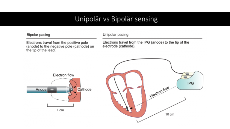 Oversensitive Pacemaker Pacemaker Overview: Device and Electrodes Explained - The Anesthesia Guide