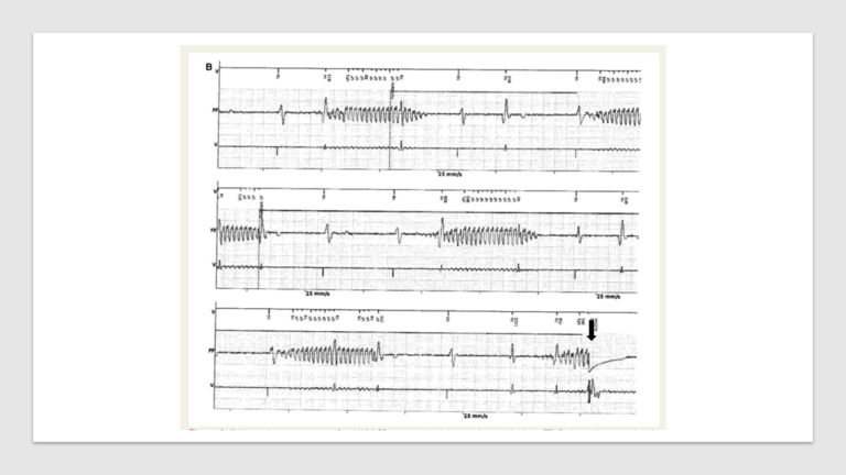 Heart Rate Mschart Pacemaker Pacemaker Overview: Device and Electrodes Explained - The Anesthesia Guide