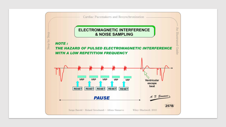 Pacemaker Overview: Device and Electrodes Explained - The Anesthesia Guide