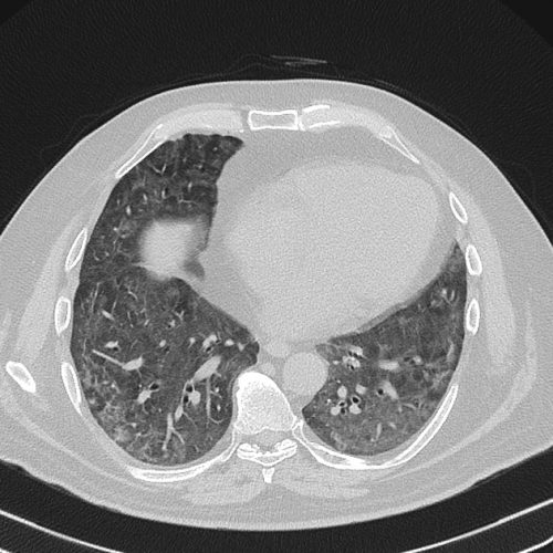 Idiopathic Interstitial Pneumonias (IIP) and Pulmonary Fibrosis - The ...