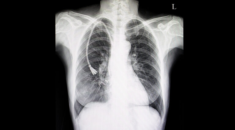 Central venous catheter – CVC insertion – indications, technique and ...