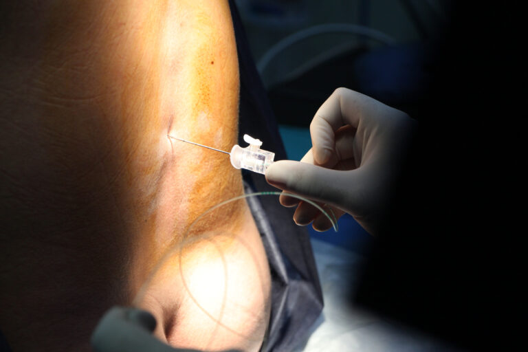 Spinal anesthesia – technique, indications and clinical use - The ...